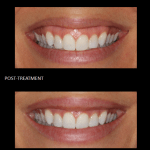 Gummy Smile before and after 5