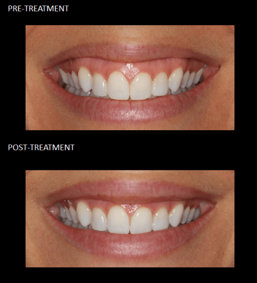 Gummy Smile before and after 5