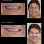 Ceramic Restorations; A happy patient with her new smile. Improved teeth shape, and color.
