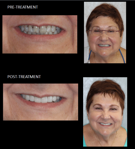 Ceramic Restorations; A happy patient with her new smile. Improved teeth shape, and color.