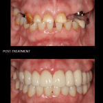 Full mouth reconstruction,