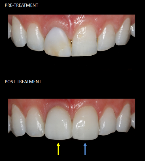 Front teeth restored with a single implant (yellow) and a matching veneer (blue).