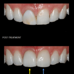 Front teeth restored with a single implant (yellow) and a matching veneer (blue).