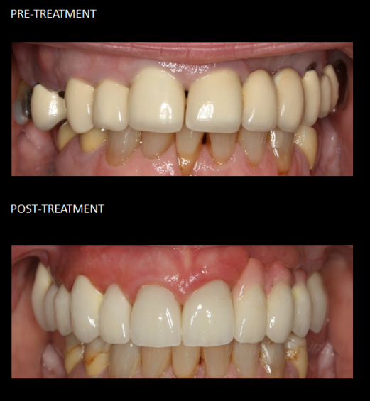 Cosmetic and functional rehabilitation of the upper teeth with crowns and implants