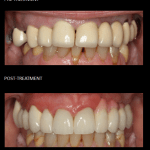 Cosmetic and functional rehabilitation of the upper teeth with crowns and implants