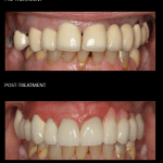 Rehabilitación estética y funcional de los dientes superiores con coronas e implantes