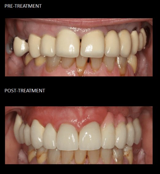 Rehabilitación estética y funcional de los dientes superiores con coronas e implantes