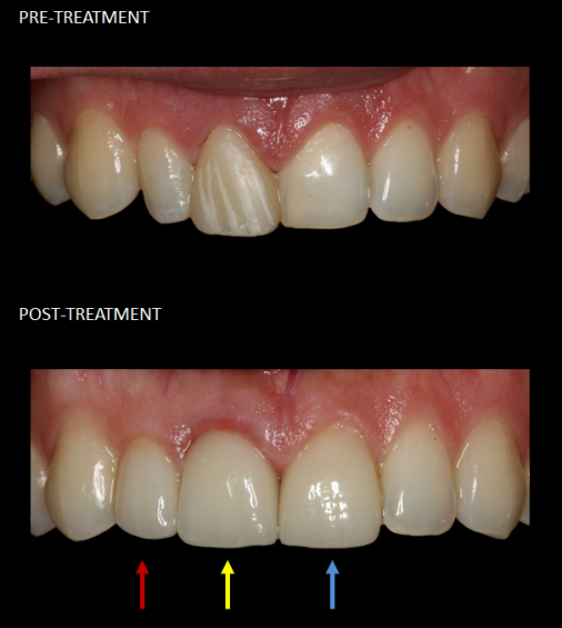 Restoration of front teeth with a crown (red), implant (yellow), and veneer (blue).