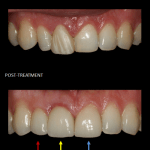 Restoration of front teeth with a crown (red), implant (yellow), and veneer (blue).