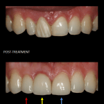 Restoration of front teeth with a crown (red), implant (yellow), and veneer (blue).