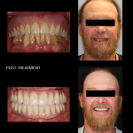 Replacement of a denture and teeth failing from gum disease with implant bridges, using All-On-Four and Teeth-in-a-Day.