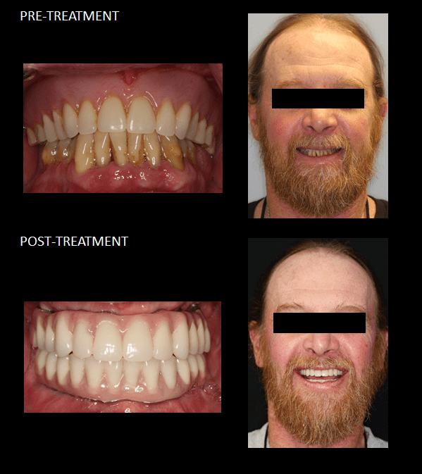 Reemplazo de una dentadura postiza y dientes que fallan por enfermedad de las encías con puentes de implantes, usando All-On-Four y Teeth-in-a-Day.