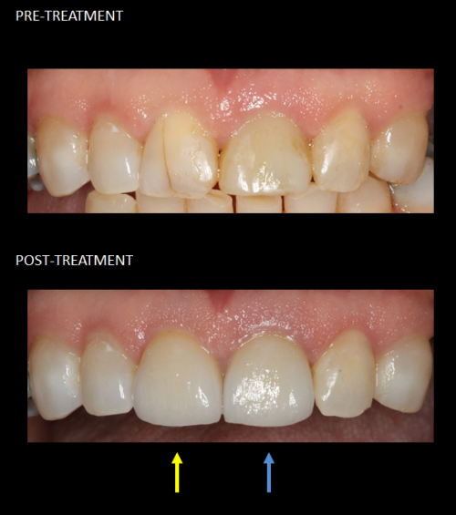 Restoration of front teeth with a same-day implant (blue) and matching crown (yellow).