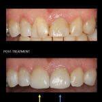 Restoration of front teeth with a same-day implant (blue) and matching crown (yellow).