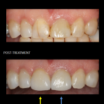Restauración de los dientes frontales con un implante en el mismo día. (azul) y corona a juego (amarillo).