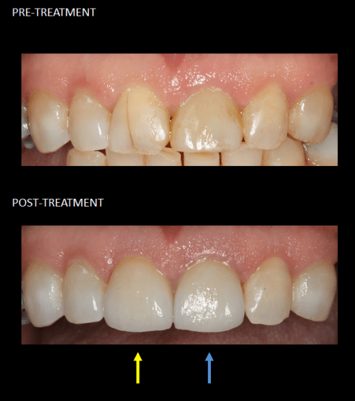 Restoration of front teeth with a same-day implant (blue) and matching crown (yellow).