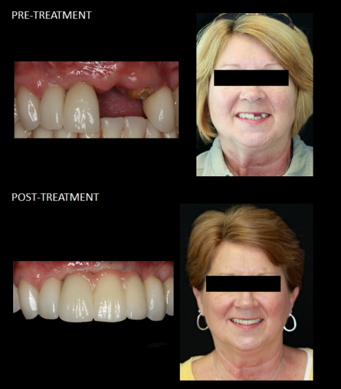 Using implants to replace a missing tooth and a fractured tooth.