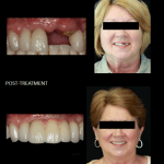 Using implants to replace a missing tooth and a fractured tooth.