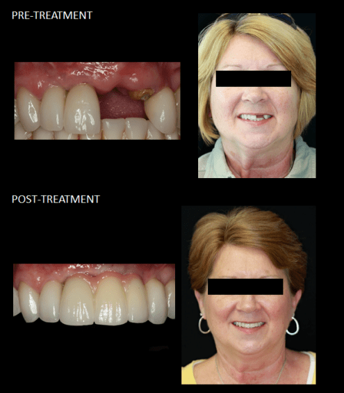 Uso de implantes para reemplazar un diente faltante y un diente fracturado.