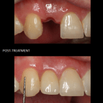 Single tooth implant placed on the day of extraction.