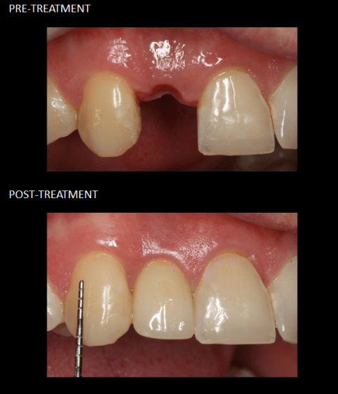 Single tooth implant placed on the day of extraction.