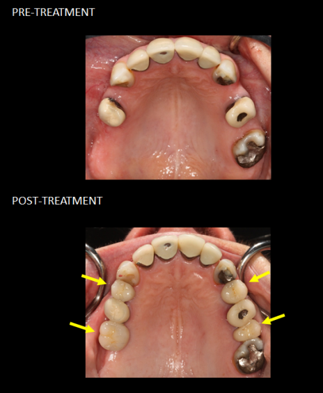 Replacement of four missing teeth with implants.