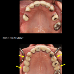 Replacement of four missing teeth with implants.