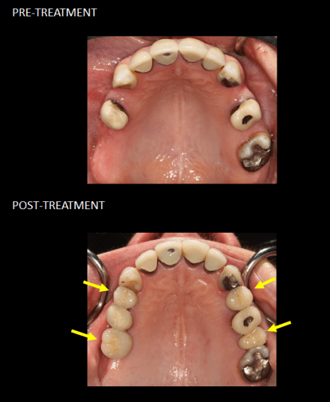 Reemplazo de cuatro dientes faltantes con implantes.
