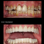 Full mouth reconstruction with crowns and bridges (completed in 3 appointments).
