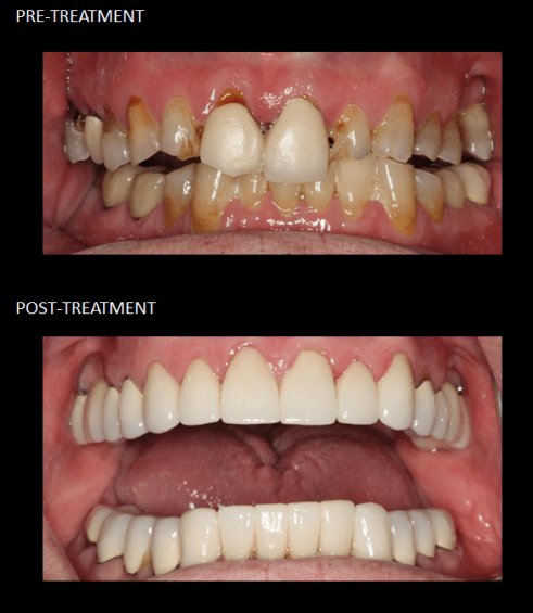 Full mouth reconstruction with crowns and bridges (completed in 3 appointments).