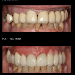 Cosmetic and functional rehabilitation of the upper teeth with crowns and implants