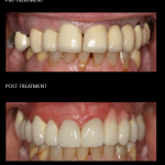 Cosmetic and functional rehabilitation of the upper teeth with crowns and implants