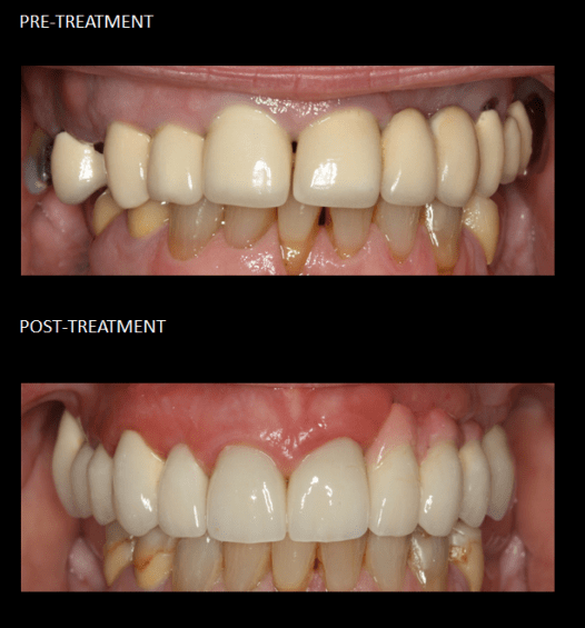 Cosmetic and functional rehabilitation of the upper teeth with crowns and implants