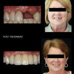 Using implants to replace a missing tooth and a fractured tooth