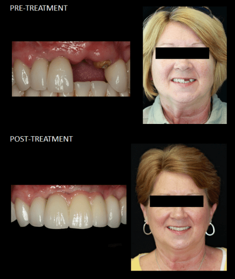 Using implants to replace a missing tooth and a fractured tooth