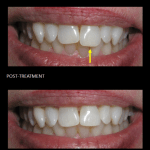 Re-shaping a long front tooth, making this dramatic esthetic improvement to her smile.