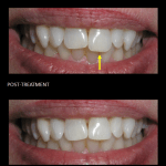 Re-shaping a long front tooth, making this dramatic esthetic improvement to her smile.