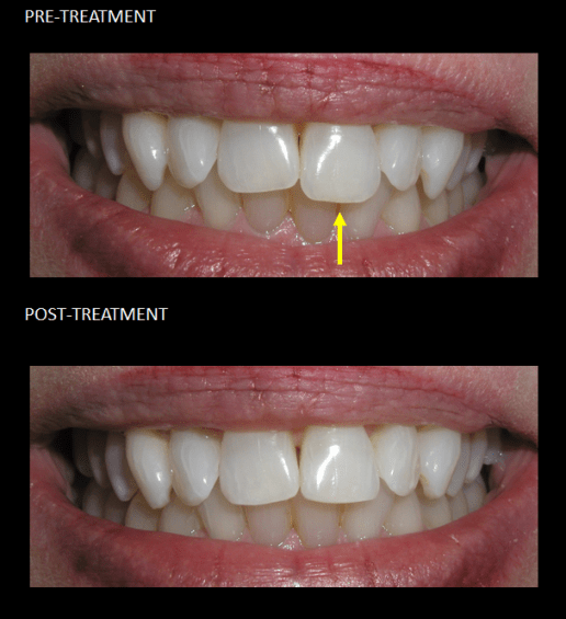 Re-shaping a long front tooth, making this dramatic esthetic improvement to her smile.