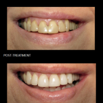 Cosmetic Bonding, used to alter our patient’s teeth shape and color.