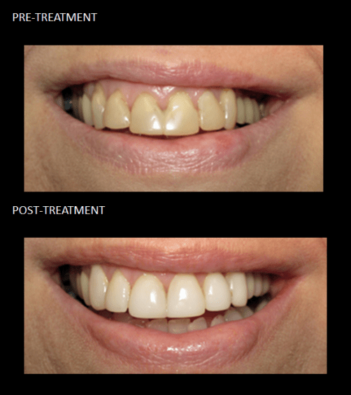 Cosmetic Bonding, used to alter our patient’s teeth shape and color.