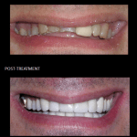 Full mouth reconstruction, using ceramic crowns improving his function