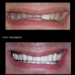 Full mouth reconstruction, using ceramic crowns improving his function