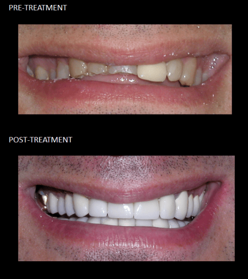 Full mouth reconstruction, using ceramic crowns improving his function
