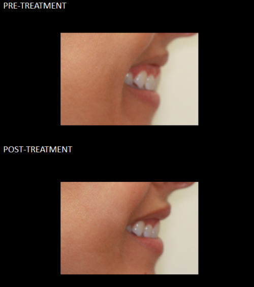 Gummy Smile before and after 4