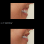 Gummy Smile before and after 4