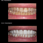 Ceramic crowns used to modify our patient’s discolored enamel.