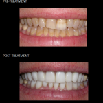 Ceramic crowns used to modify our patient’s discolored enamel.