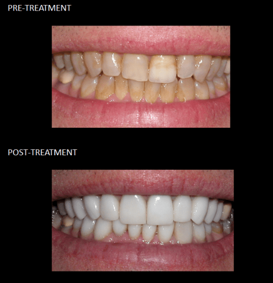 Ceramic crowns used to modify our patient’s discolored enamel.