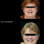 Full mouth reconstruction, with crowns and implants