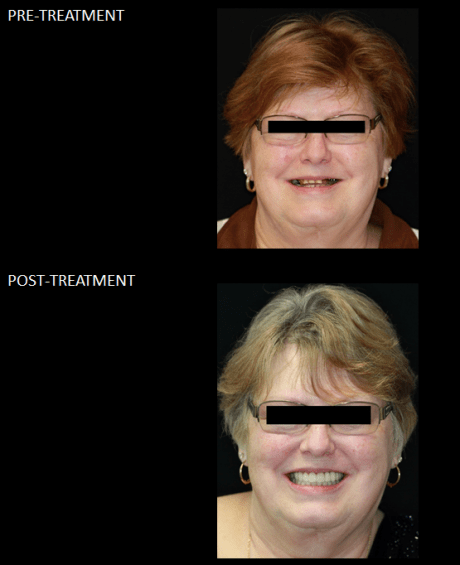 Reconstrucción de boca completa, con coronas e implantes
